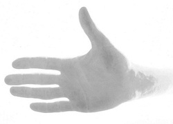 Normal_hand_reuma